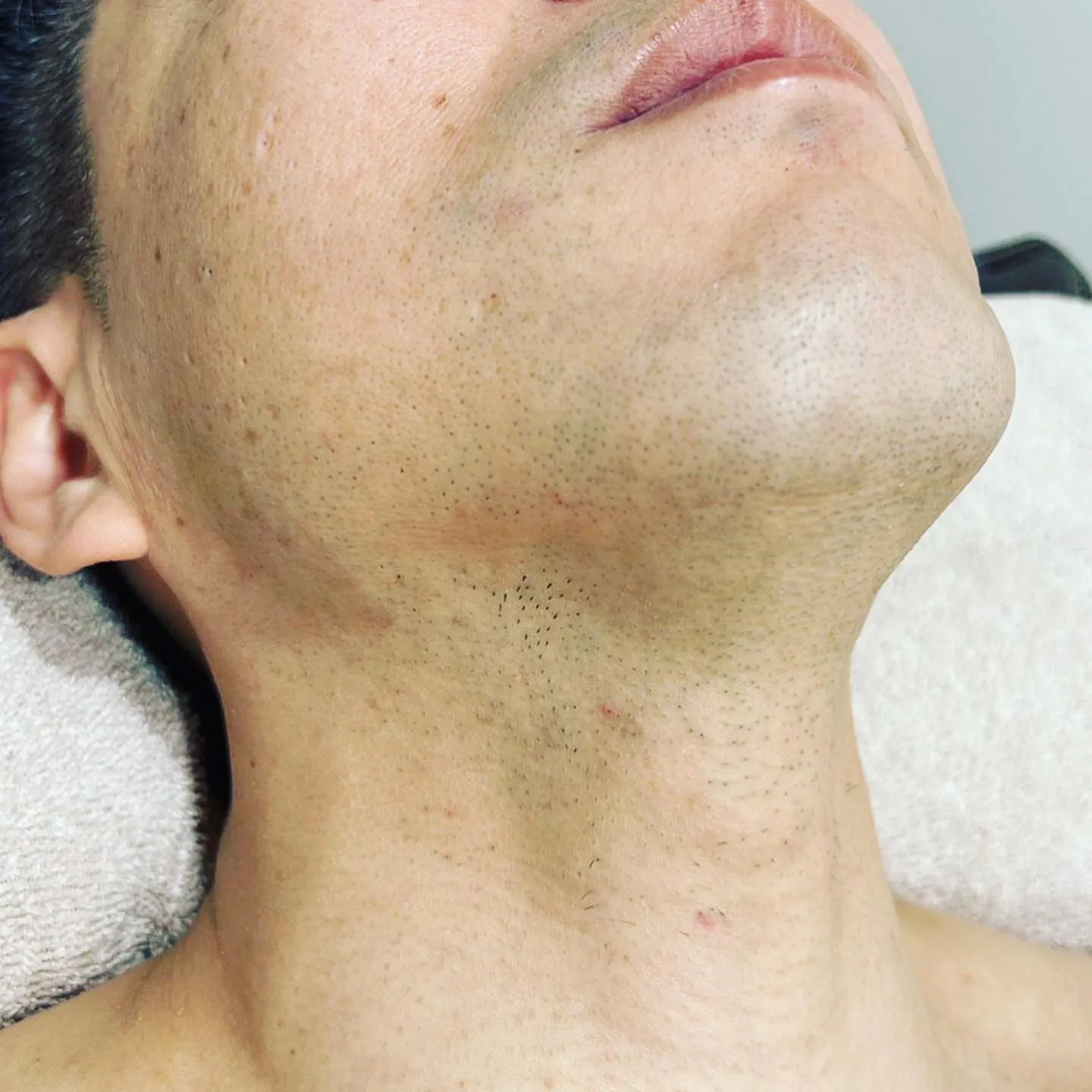 脱毛経過報告✨