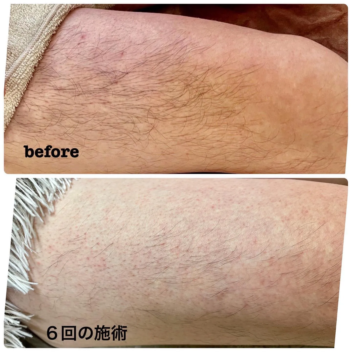 たまプラーザの脱毛サロンクレビーです。