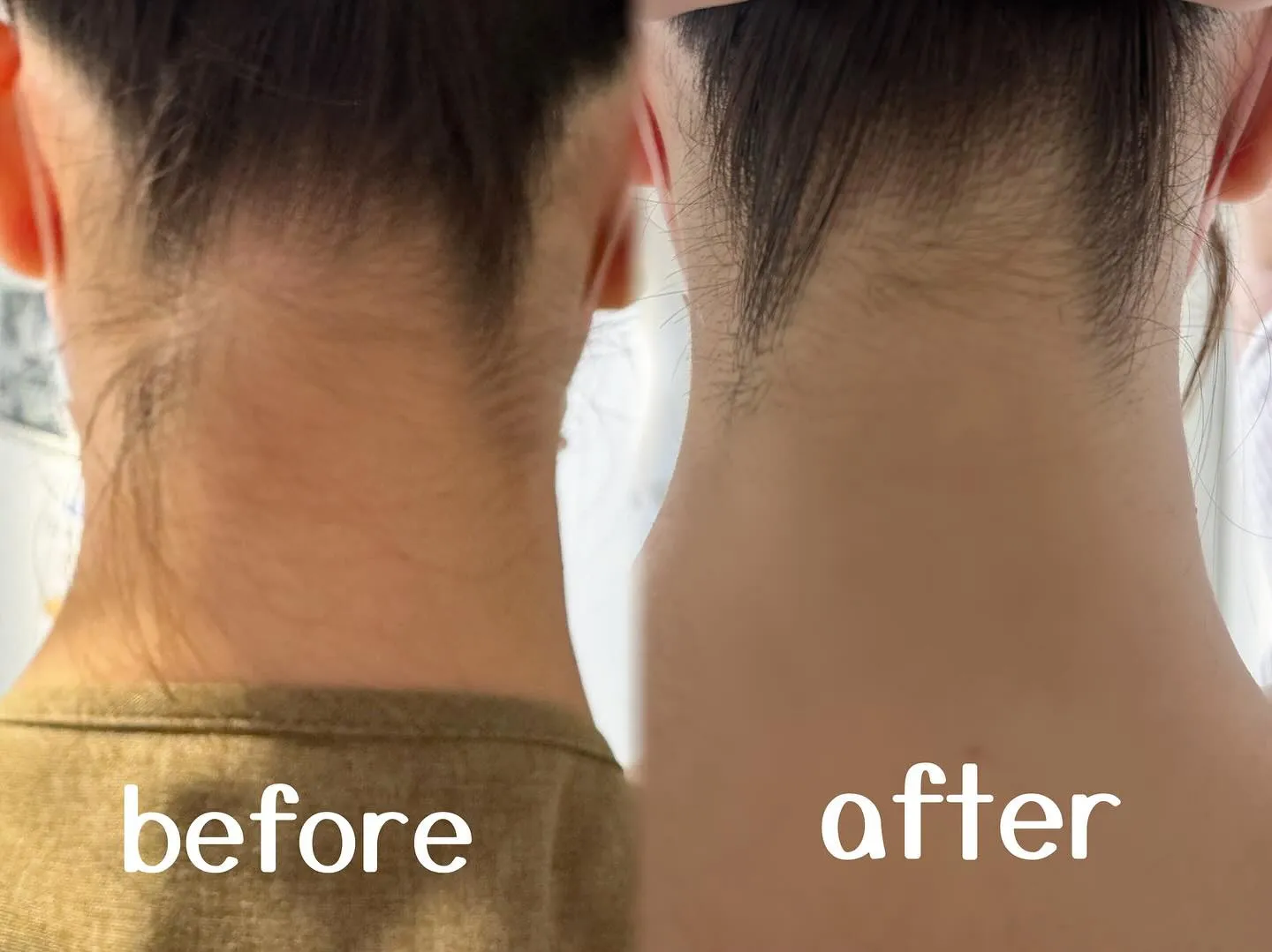 うなじ脱毛1回目のビフォーアフター写真です！